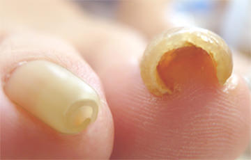 Severe ingrown nail