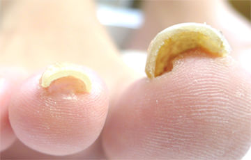 Split the treatment in several times for severely deformed nail.