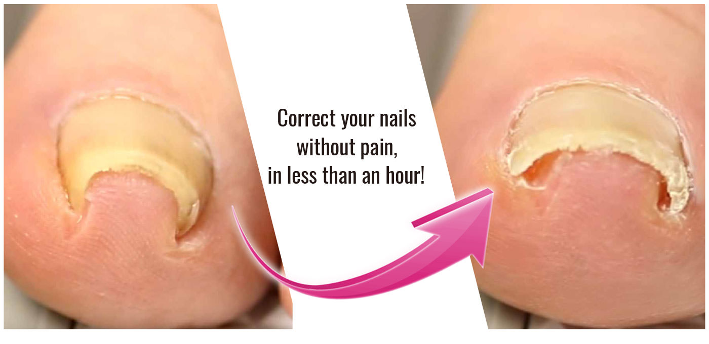 Correct your nails without pain, in less than an hour!